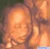 ecograf&iacute;a en 3 dimensiones de Bea con 20 semanas de gestacion